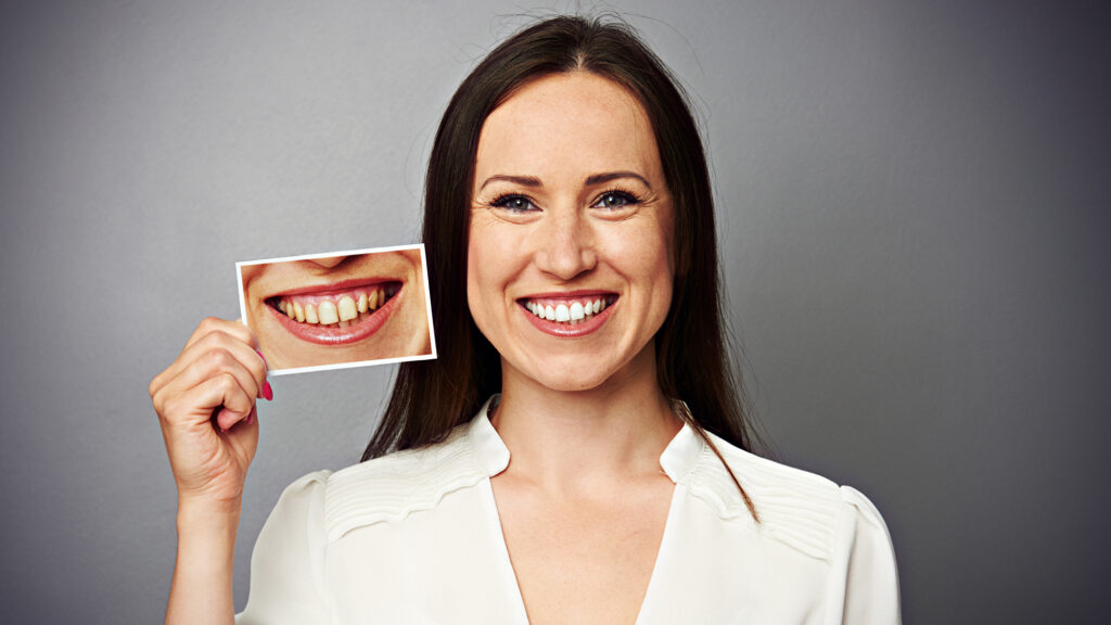 Woman comparing tooth shades to demonstrate professional teeth whitening results