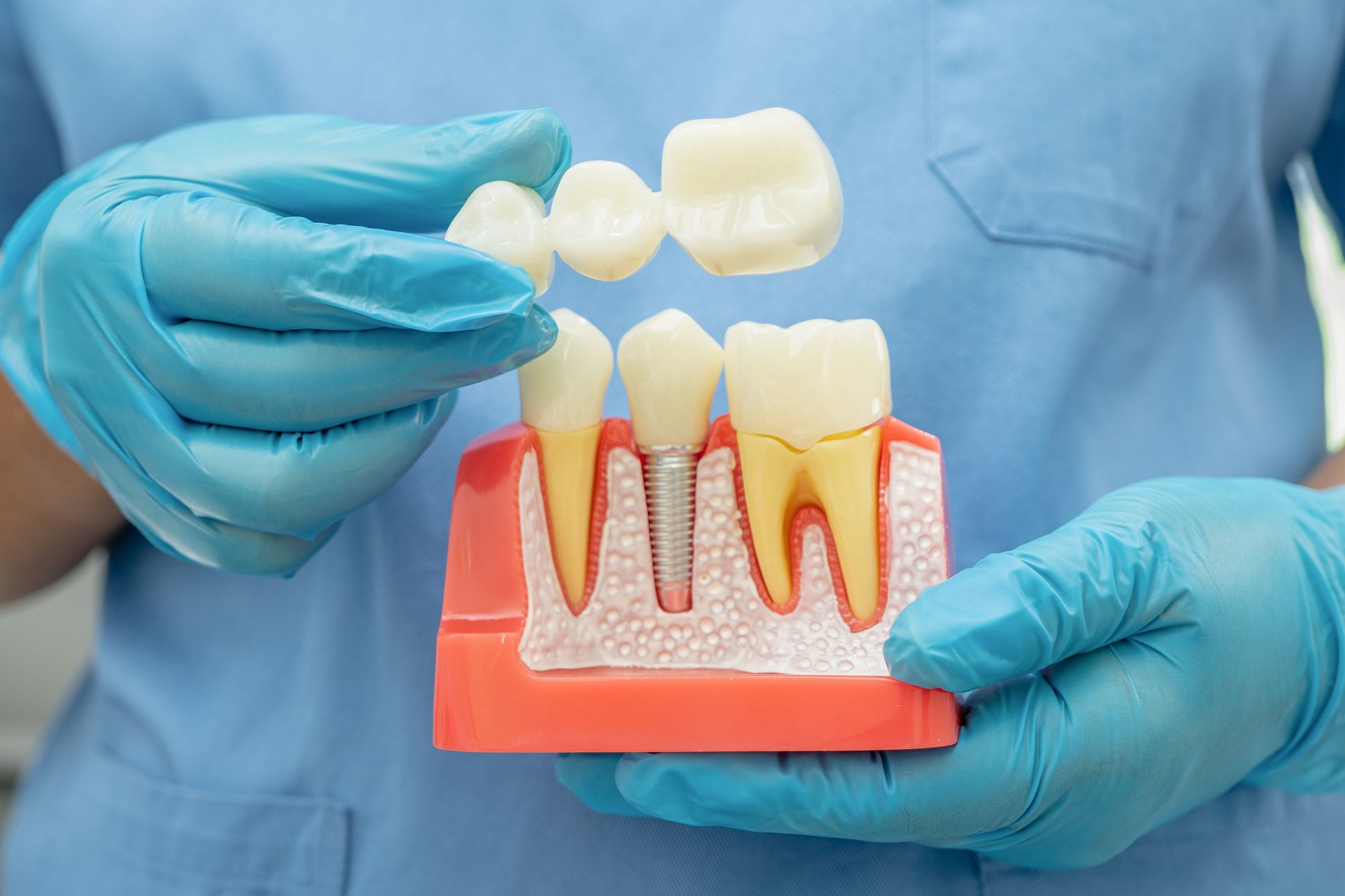 Dental implant model showing an artificial tooth and implant root for missing tooth replacement